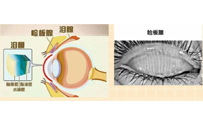 運用強脈沖光治療瞼板腺功能障礙相關干眼癥